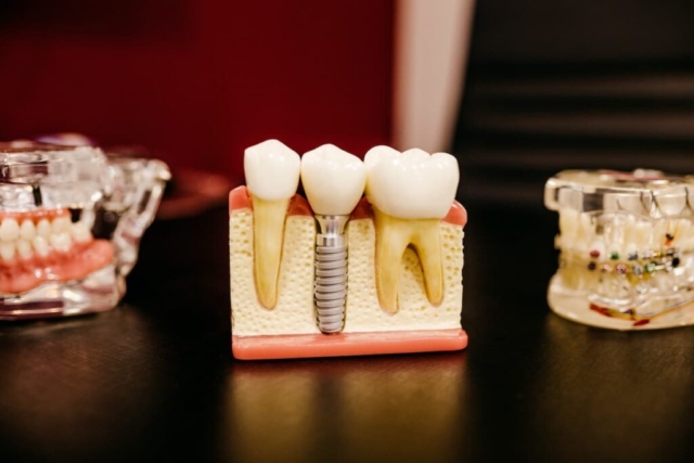 Everything you need to know before going for a Dental Implant